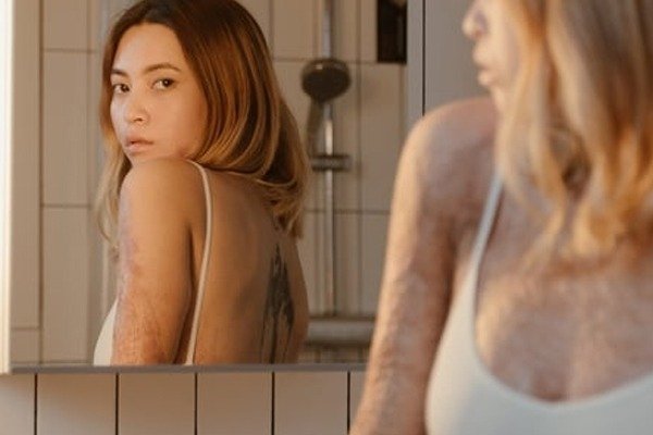 5 helpful skincare tips to treat skin burns